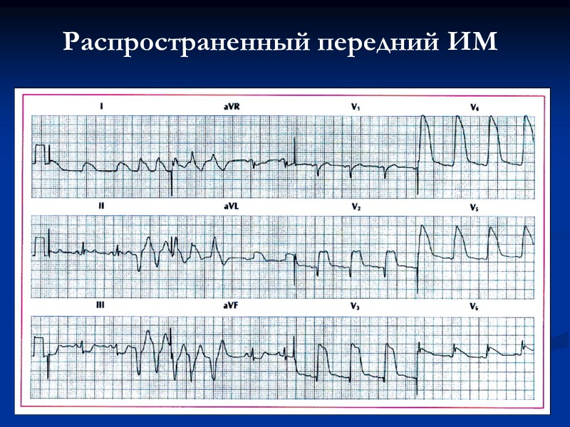 Распространенный передний ИМ